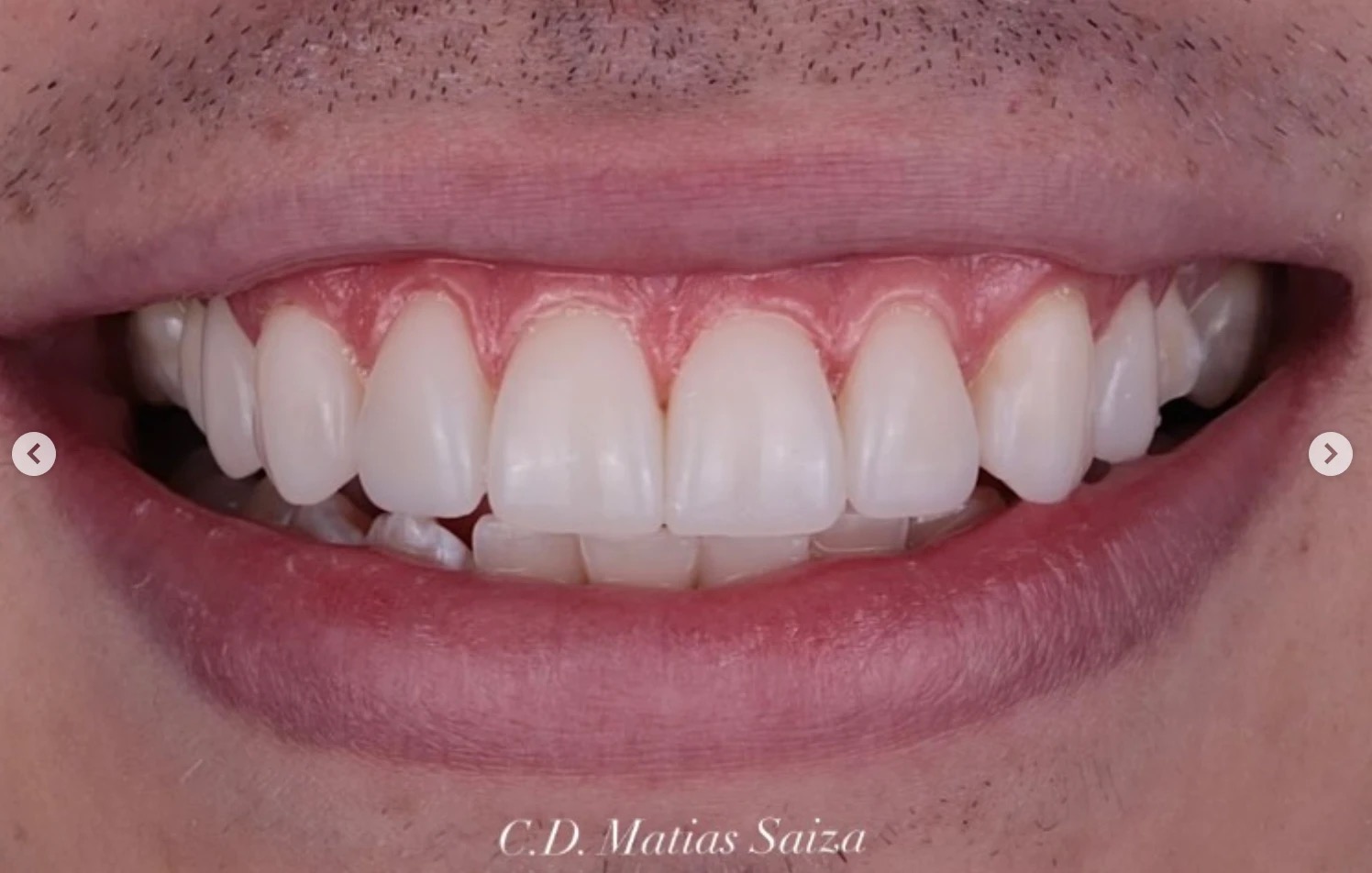 Cosmetic dentistry result - Dr. Matias Saiza