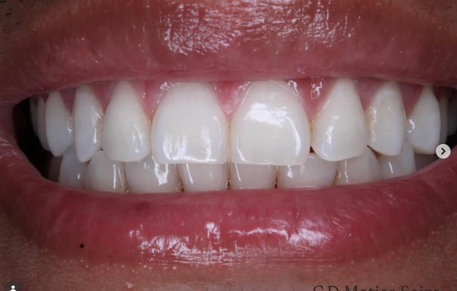 Cosmetic dentistry result - Dr. Matias Saiza