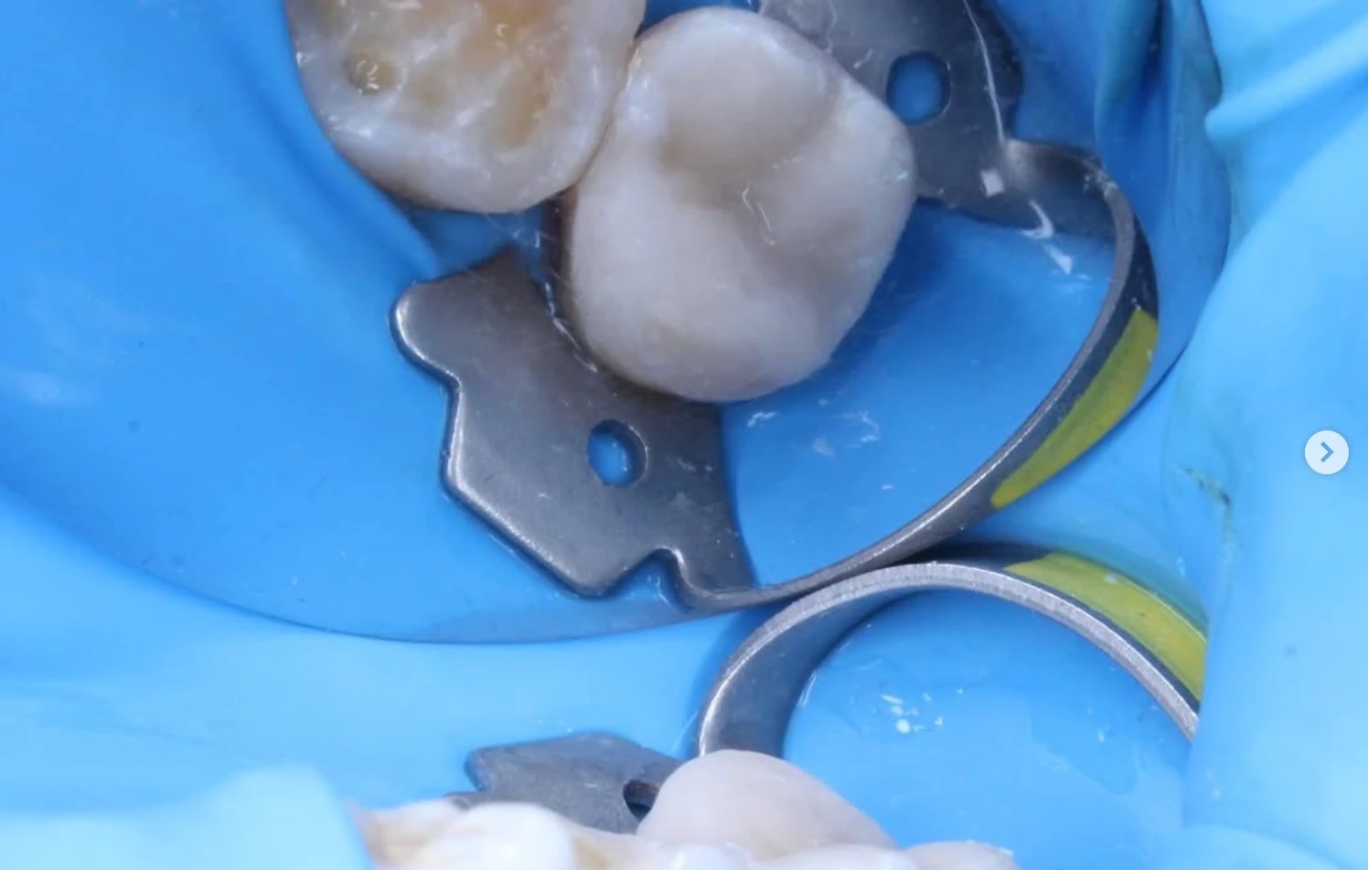 Restorative dentistry result - Dr. Matias Saiza