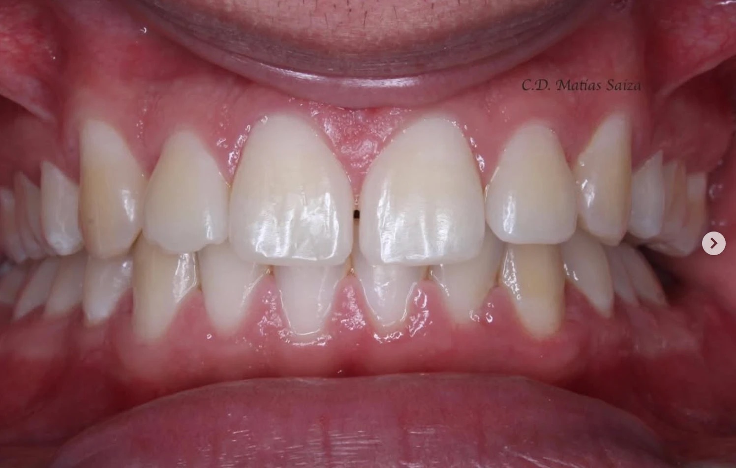 Dental treatment detail - Dr. Matias Saiza